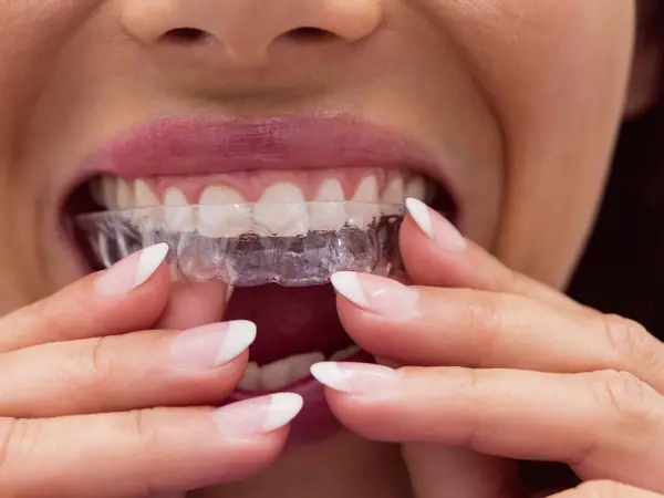Mujer colocándose un alineador transparente de ortodoncia invisible